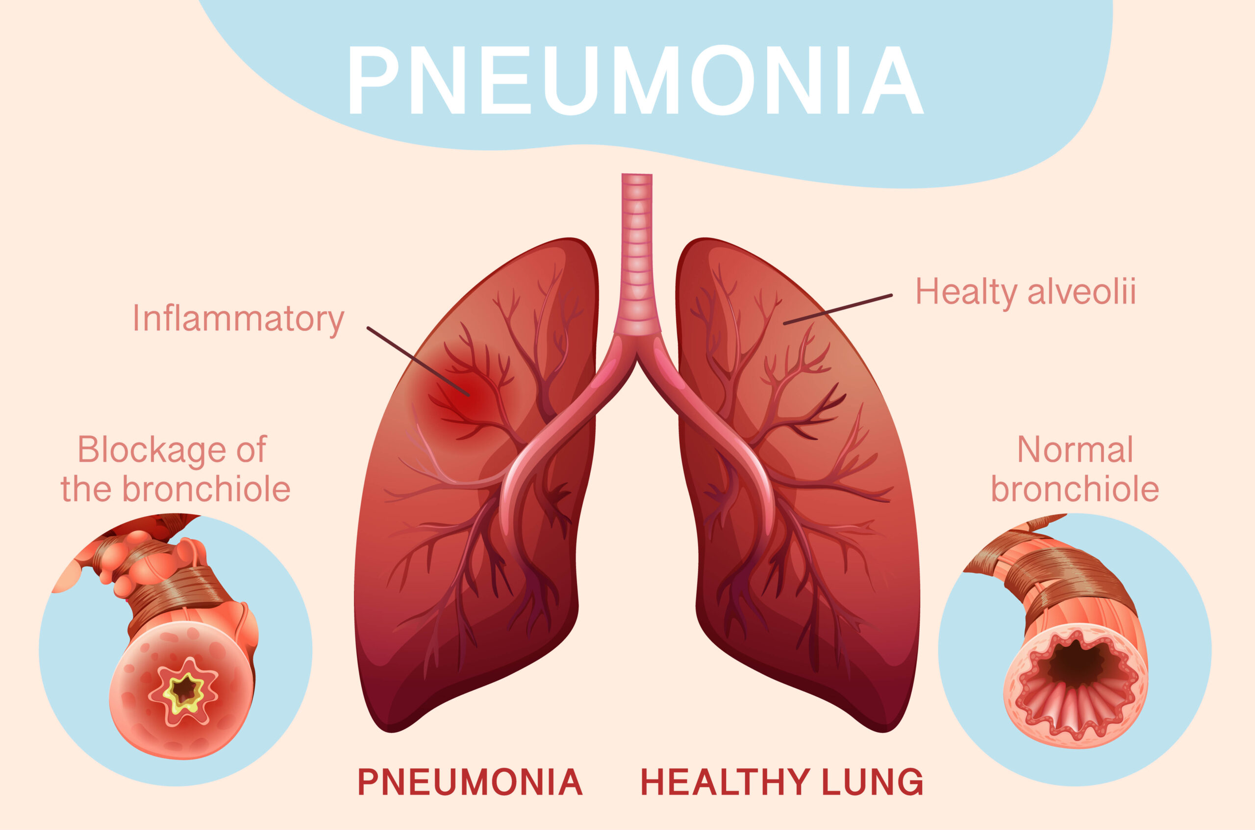 pnemunonia